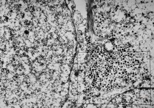 F, 71y. | Merkel cell tumor